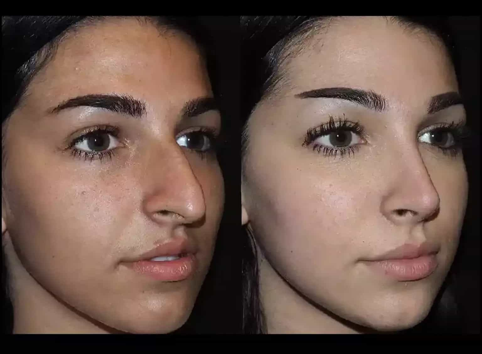 Rhinoplasty in Dubai
