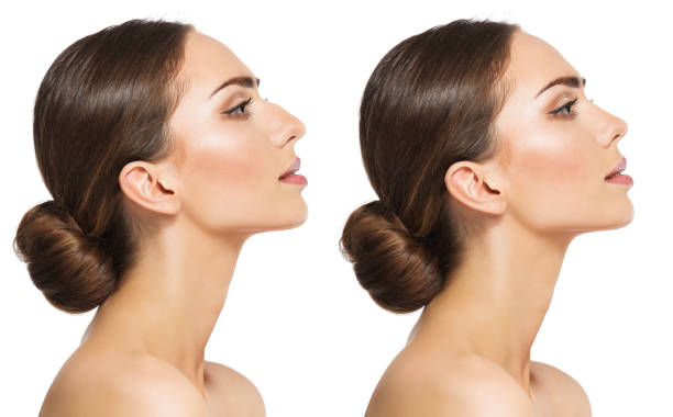 Rhinoplasty in Riyadh