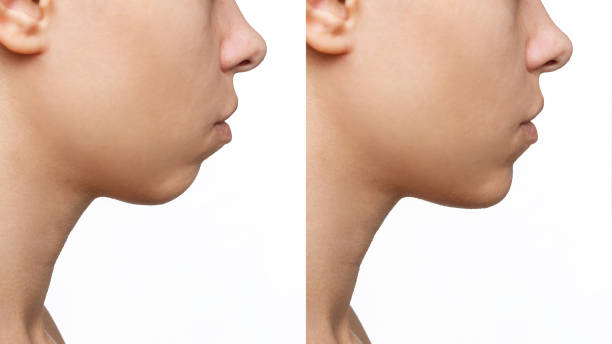 Fat Freezing vs. Laser Lipolysis for Double Chin Removal in Abu Dhabi